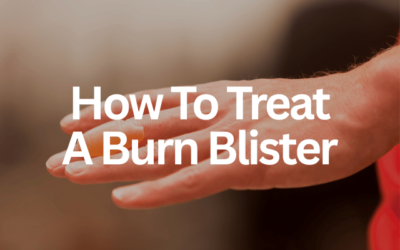 How to Treat a Burn Blister